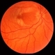 BRAO with Cilioretinal Sparing BRAO with Cilioretinal Sparing